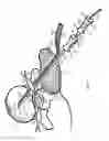 Fig. 07 - INTERNAL AND EXTERNAL DISC SHUNT ALLEVIATE BACK PAIN