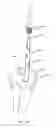 Fig. 22 - Method and device for delivering medicine to bone