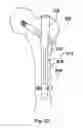 Fig. 35 - Method and device for delivering medicine to bone