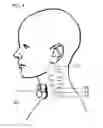 Fig. 09 - Devices and methods for non-invasive capacitive electrical stimulation and their use for vagus nerve stimulation on the neck of a patient