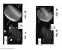 Fig. 09 - Neurostimulation programmers with improved RF antenna radiation patterns