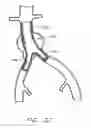 Fig. 22 - Graft deployment system