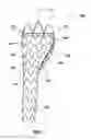 Fig. 02 - Stent Graft System and Method of Use