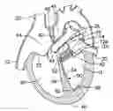 Fig. 01 - Method of reshaping a ventricle