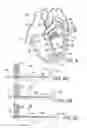 Fig. 04 - Method of reshaping a ventricle