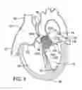 Fig. 06 - Method of reshaping a ventricle