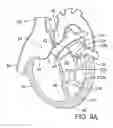 Fig. 07 - Method of reshaping a ventricle