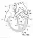 Fig. 08 - Method of reshaping a ventricle
