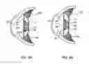 Fig. 04 - Method and apparatus for anchoring an intraocular lens assembly