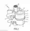Fig. 02 - Spine surgery method and instrumentation