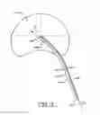 Fig. 03 - Spine surgery method and instrumentation