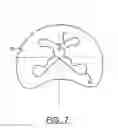 Fig. 08 - Spine surgery method and instrumentation