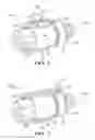 Fig. 06 - Camshaft phaser intermediate locking pin and seat