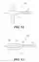 Fig. 11 - CRICOID MANIPULATING APPARATUS FOR ANESTHESIA ASSISTANCE AND TRACHEAL INTUBATION