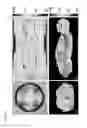 Fig. 02 - Method and coils for human whole-body imaging at 7 T