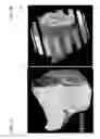 Fig. 13 - Method and coils for human whole-body imaging at 7 T
