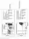 Fig. 02 - Methods for treating progressive multifocal leukoencephalopathy (PML)