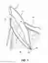 Fig. 02 - Apparatus for evacuation of root canal