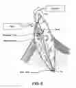 Fig. 06 - Apparatus for evacuation of root canal