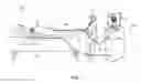 Fig. 02 - Catheter entanglement indication