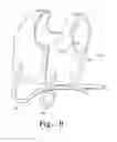 Fig. 09 - Data handling for high frequency chest wall oscillation system
