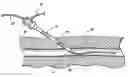 Fig. 01 - SYSTEM AND METHOD FOR ESTABLISHING VASCULAR ACCESS