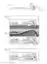 Fig. 02 - Method and System for Cryoablating Fibroadenomas