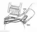 Fig. 01 - Apparatuses and methods for forming incisions in ocular tissue