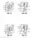Fig. 19 - Apparatuses and methods for forming incisions in ocular tissue