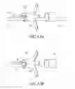 Fig. 10 - Method of implanting an adjustable occlusion device