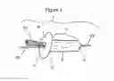 Fig. 02 - Tissue Plug