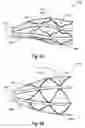 Fig. 09 - BISTABLE BODY LUMEN FILTER ANCHORS