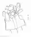 Fig. 04 - Multiple facet joint replacement