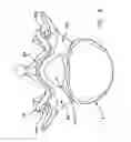 Fig. 06 - Multiple facet joint replacement