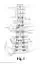 Fig. 02 - LOCKING MECHANISMS FOR PIVOTING BONE ANCHORS
