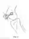 Fig. 06 - Internal joint bracing system and suture anchoring assembly therefore