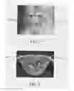 Fig. 02 - METHOD FOR TREATING DEGENERATIVE DISC DISEASE USING NONINVASIVE CAPACITIVELY COUPLED ELECTRICAL STIMULATION DEVICE