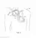 Fig. 02 - Method and apparatus for fixating an implantable medical device