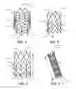 Fig. 02 - STENT FOR VALVE REPLACEMENT