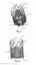 Fig. 03 - STENT FOR VALVE REPLACEMENT