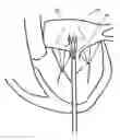 Fig. 01 - Truncated Conical Heart Valve Stent with Anchoring Threads and Methods of Use