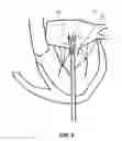 Fig. 06 - Truncated Conical Heart Valve Stent with Anchoring Threads and Methods of Use
