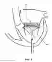 Fig. 07 - Truncated Conical Heart Valve Stent with Anchoring Threads and Methods of Use