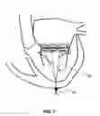 Fig. 08 - Truncated Conical Heart Valve Stent with Anchoring Threads and Methods of Use
