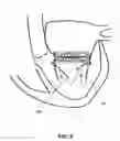 Fig. 09 - Truncated Conical Heart Valve Stent with Anchoring Threads and Methods of Use