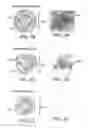 Fig. 03 - Therapy for lysosomal enzyme deficiencies