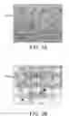 Fig. 04 - Therapy for lysosomal enzyme deficiencies