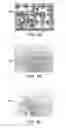 Fig. 05 - Therapy for lysosomal enzyme deficiencies