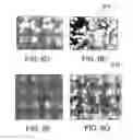 Fig. 11 - Therapy for lysosomal enzyme deficiencies