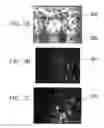 Fig. 12 - Therapy for lysosomal enzyme deficiencies